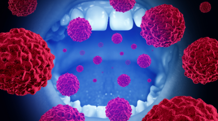 OropharyngealCancer-1